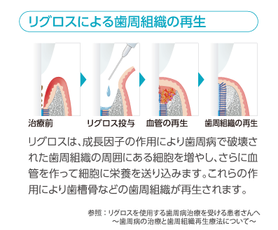 リグロス🄬再生療法の手順